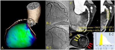 Coronary Computed Tomography Angiographic Predictors of Non-culprit Territory Unrecognized Myocardial Infarction Assessed by Cardiac Magnetic Resonance in Non-ST-elevation Acute Coronary Syndrome